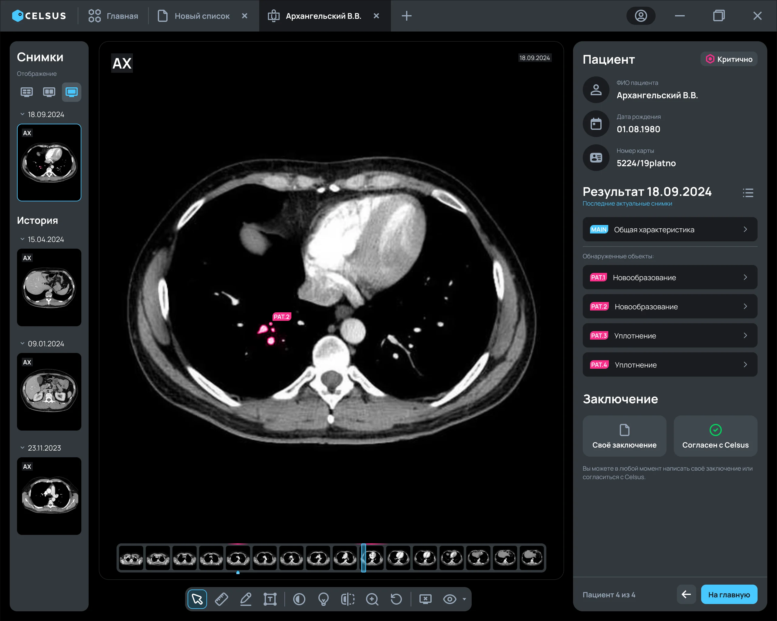 DICOM-Viewer с КТ-исследованием и результатами AI